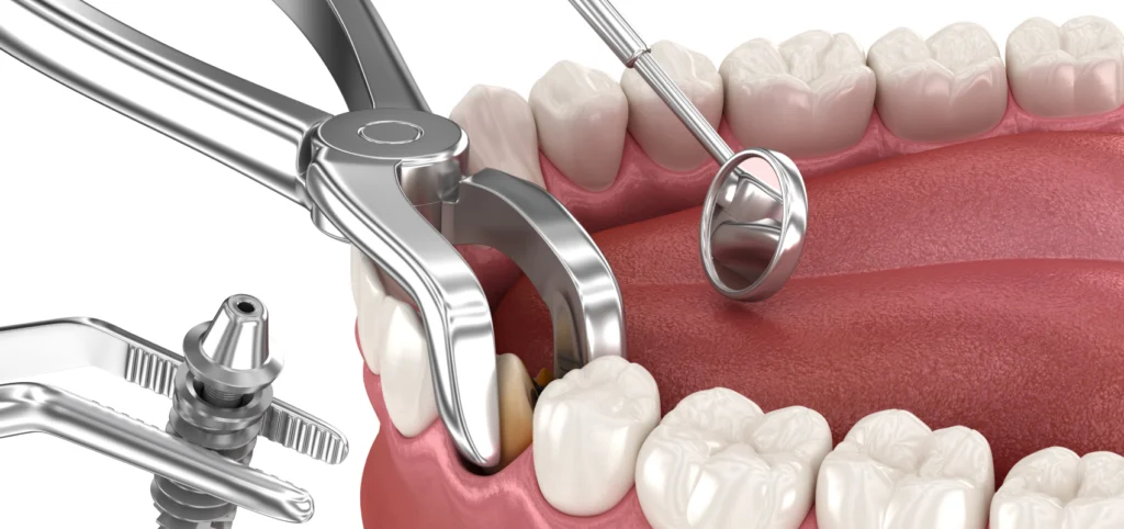 extraction implantation dentiste anthony Implantologie Cabinet dentaire Le 29 Bis, Chirurgiens-dentistes à Antony 92160