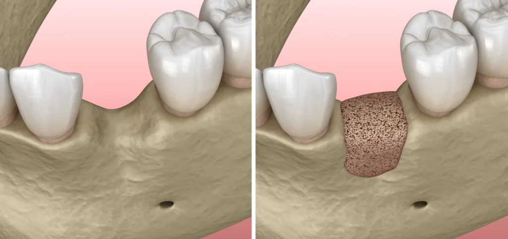 greffes osseuses parodontologie chirurgicale dentiste anthony Implantologie Cabinet dentaire Le 29 Bis, Chirurgiens-dentistes à Antony 92160