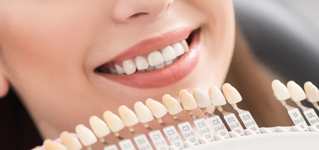 facettes dentaires Esthétique Cabinet dentaire Le 29 Bis | Chirurgiens-dentistes | Antony 92160