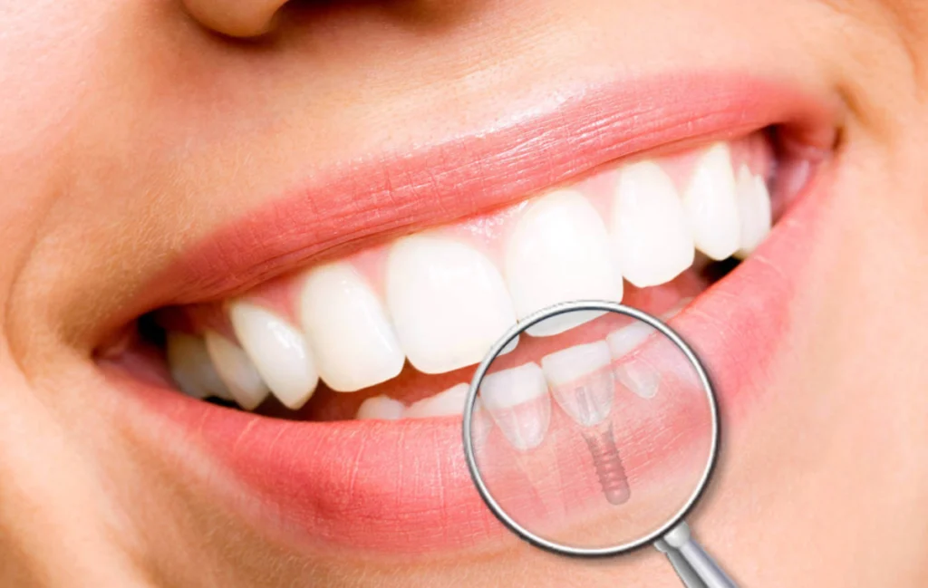 implant dentaire Implantologie Cabinet dentaire Le 29 Bis | Chirurgiens-dentistes | Antony 92160